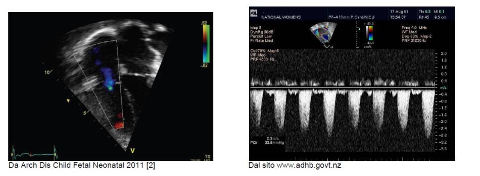 diagnosi_ipertensione_polmonare_1.jpg