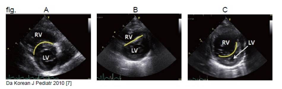 diagnosi_ipertensione_polmonare_4.jpg